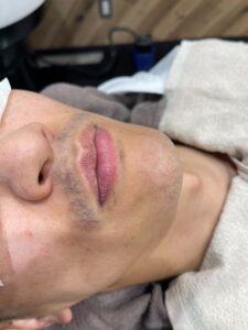 鼻下ヒゲ脱毛 施術前